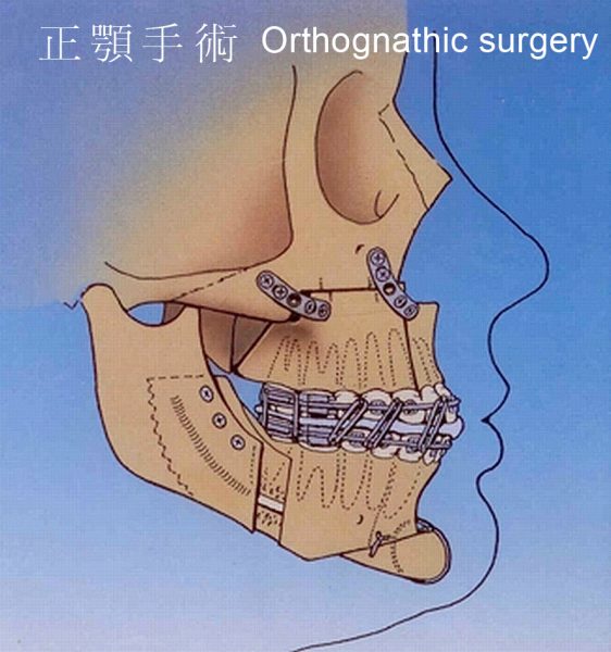 正顎手術
