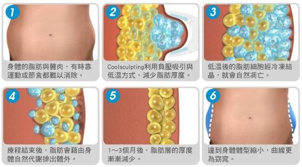 冷凍溶脂原理