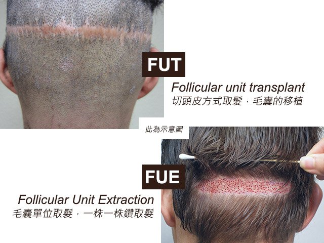 FUE FUT 植髮 後尾枕 傷口