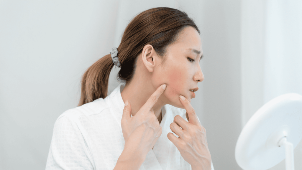 玫瑰痤瘡激光治療