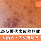 色斑反覆是否代表皮秒無效