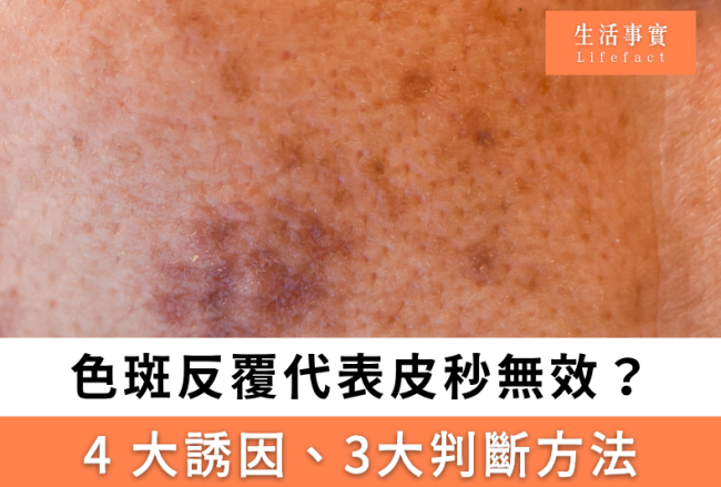 色斑反覆是否代表皮秒無效