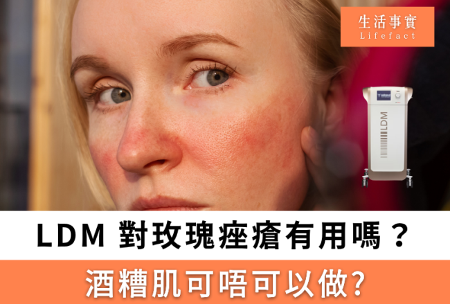 LDM 細胞機對玫瑰痤瘡有用嗎