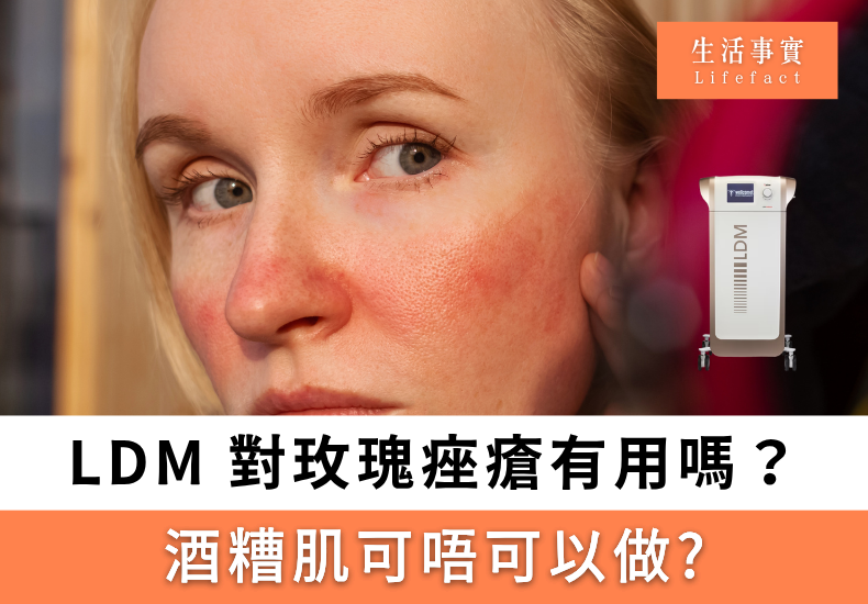 LDM 細胞機對玫瑰痤瘡有用嗎